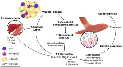 Visceral Obesity, Metabolic Syndrome, and Esophageal Adenocarcinoma